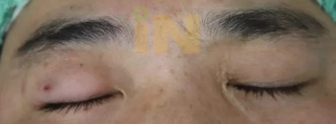 눈두덩이지방제거 수술직후