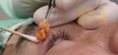조그만 구멍으로 한쪽만 제거