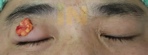 제거된 눈두덩이지방