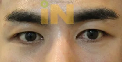 쌍꺼풀 푸는 수술후 한달 경과