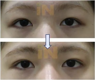 눈두덩이지방제거 전후