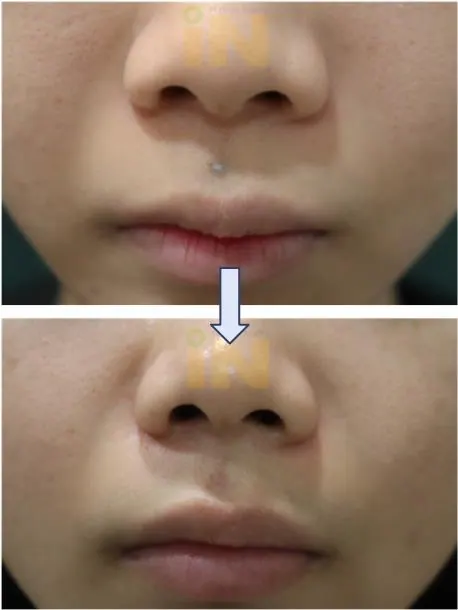인중 점제거 수술전후