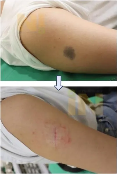 팔점제거 수술전후