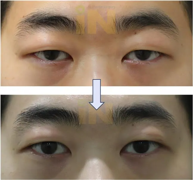 눈두덩이지방제거 전후