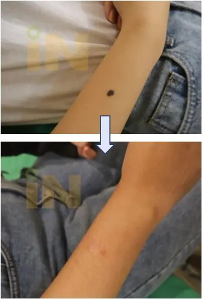 팔점제거 수술전후