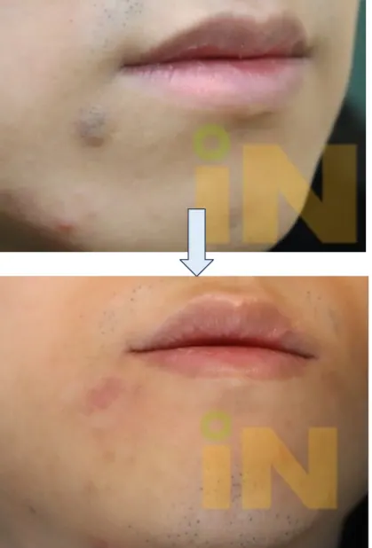 입가 점뺀 흉터 제거수술 전후