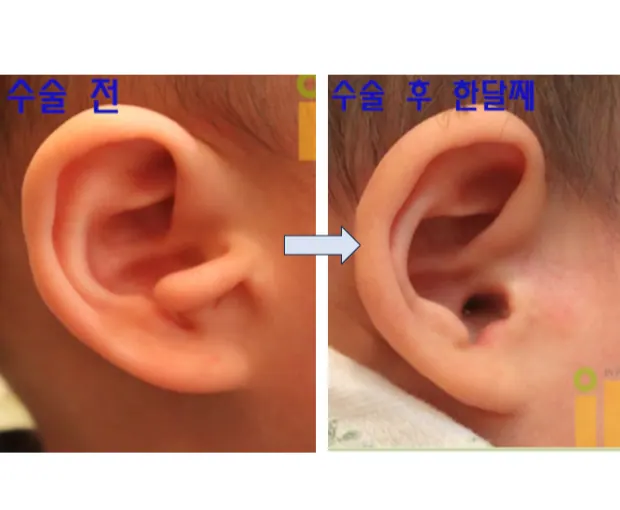 선천성 귀젖 제거 수술 전과 수술 후 한달째