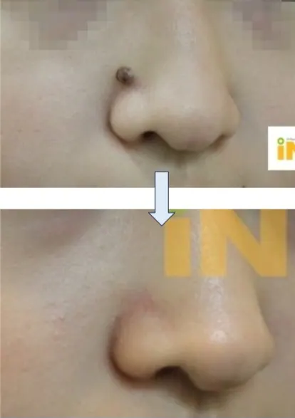 콧볼 위 검은 점제거 전후