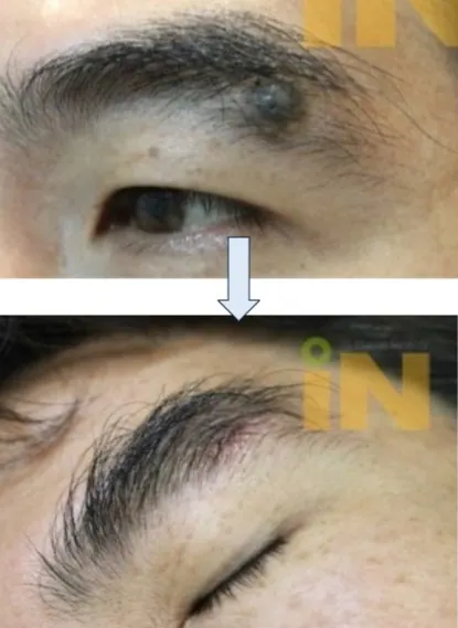 눈썹 속 푸른빛 큰점 제거 전후