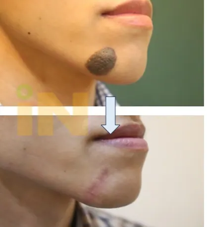 턱 볼록한 큰점 제거 전후, 측면