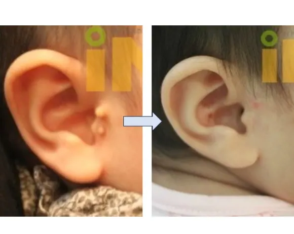 이주 위 작은 귀젖 두 개 제거 전후
