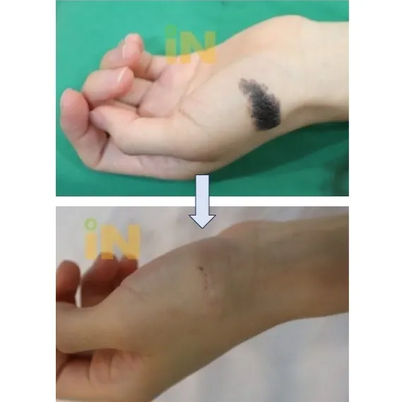 손목 선천성 모반 제거 전후