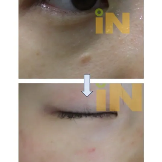 눈밑 점뺀 흉터 제거수술 전후
