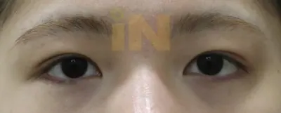 눈두덩이지방제거 한달후