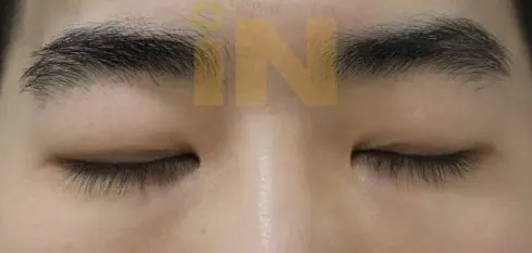비절개 쌍수라인