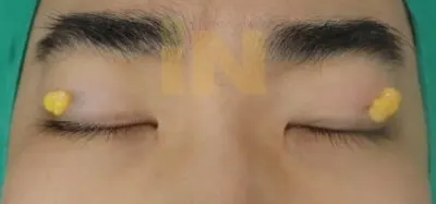 눈두덩이지방제거 수술중