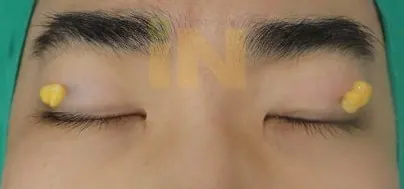 조그만 구멍을 통해 지방을 꺼낸상태