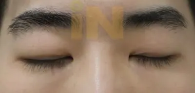 눈두덩이지방제거 수술전
