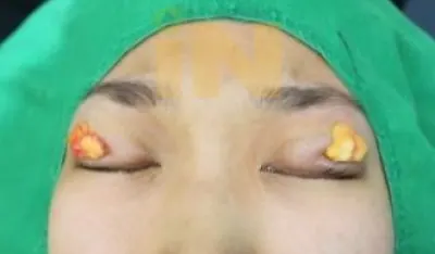 눈두덩이지방제거 작은 구멍으로 지방을 꺼낸 모습