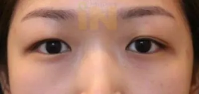 눈두덩이지방 제거 수술후