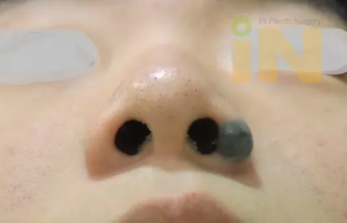 콧날개 큰점 수술전