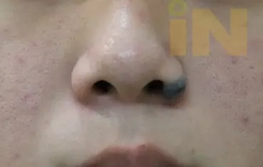 콧날개 큰점 수술전