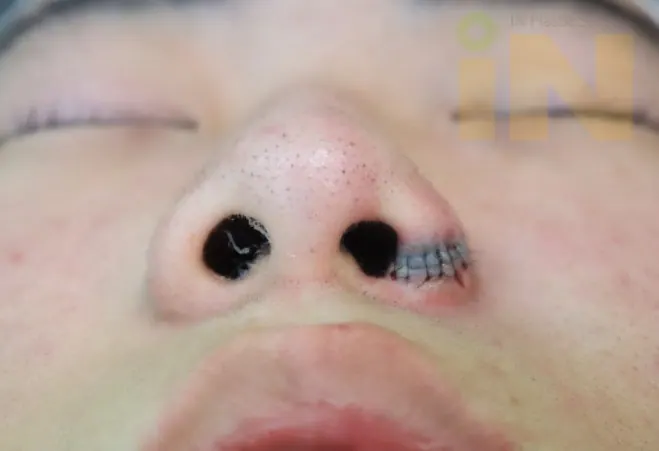 일차 제거수술 직후