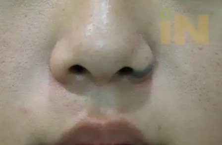 일차 수술후 한달경과