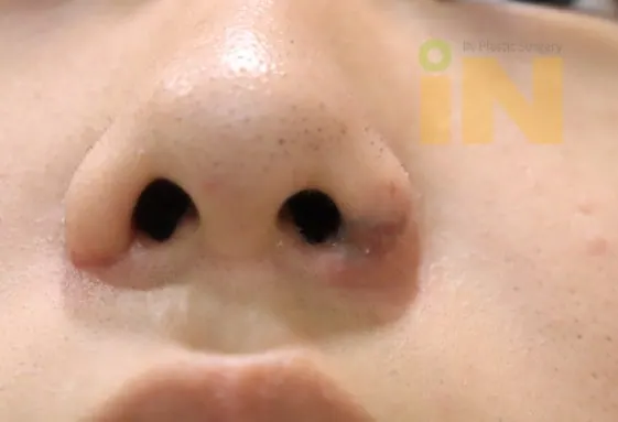 2차 수술후 한달 경과