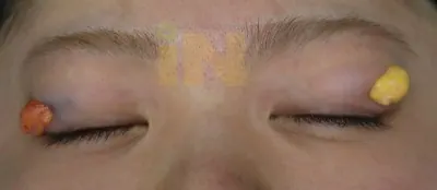 눈두덩이지방제거 수술중