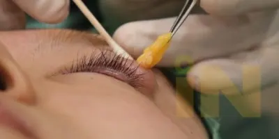 눈두덩이지방제거 수술중