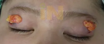 눈두덩이지방제거 수술중