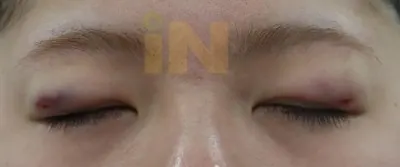 눈두덩이지방제거 수술직후 부기와 멍