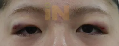 눈두덩이지방제거 수술직후 부기와 멍