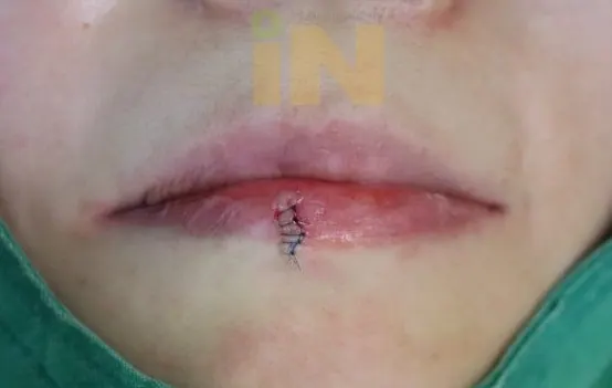 입술점제거 수술직후