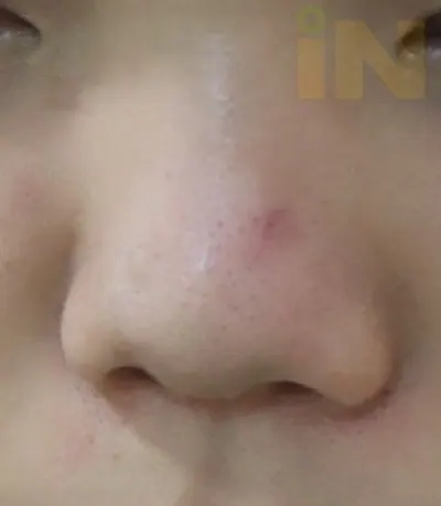 코 점제거수술 한달 경과