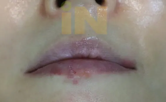 입술점제거 실밥제거 직후