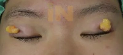 눈두덩이지방제거 술중