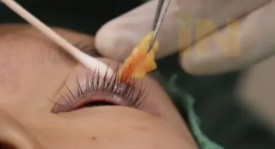 눈두덩이지방제거 술중