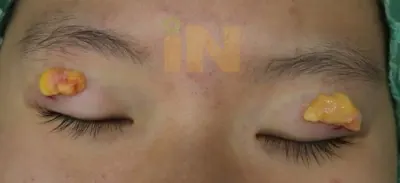 눈두덩이지방제거 술중