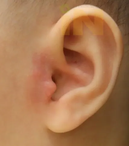 아기 스킨텍 수술후 한달