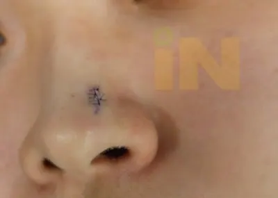 코점제거 수술직후