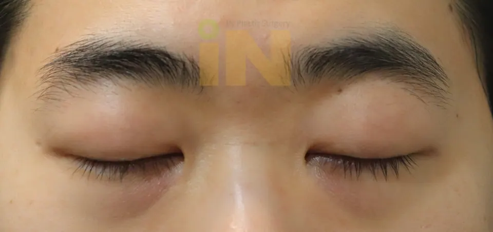 눈두덩이지방제거 수술전