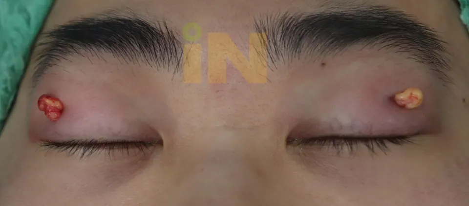 지방 일부만 약간 꺼집어낸 상태