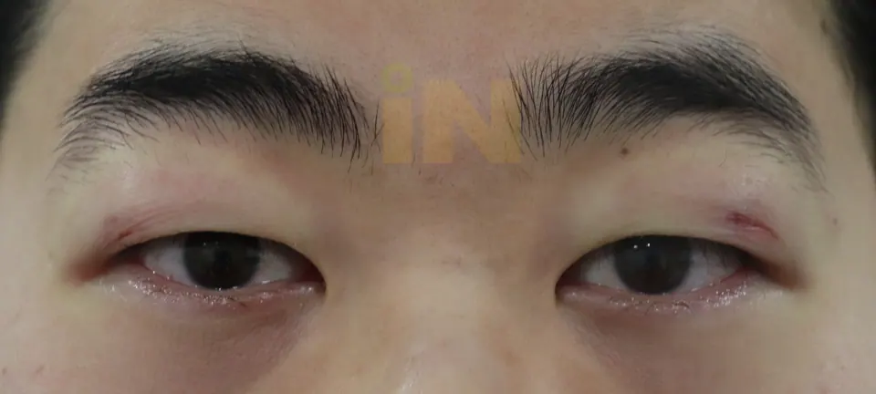 눈두덩이지방제거 수술직후 부기와 멍