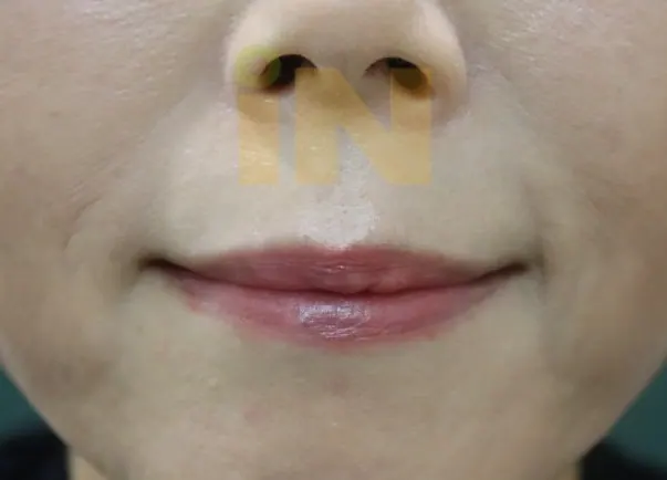 입술점제거 수술후