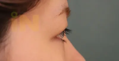 눈두덩이지방제거 수술전