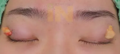 작은 구멍으로 안와지방의 일부를 꺼집어냄