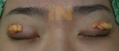 완전히 제거된 안와지방