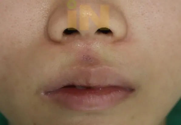 인중 점제거 수술후 5일 실밥제거직후